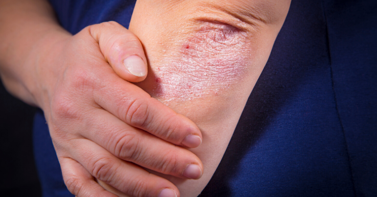 Continuing Professional Development (CPD) -
Dermatology for Primary Care Providers
Two Programs: Morning Procedural Skills + Afternoon Classroom Learning
April 24, 2020 | Donald Gordon Centre
Learn More