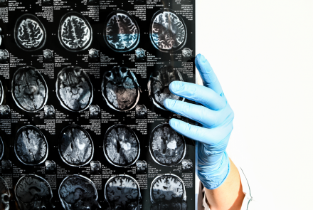 Using brain imaging to determine if patients with epilepsy are suitable for surgery